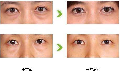去眼袋术前术后2.jpg