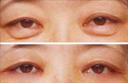 去眼袋术前术后3.jpg