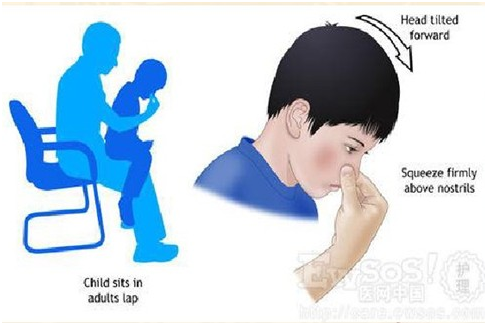 鼻出血小妙招，流鼻血止血方法，流鼻血了怎么办，眼耳鼻咽喉，鼻血.png
