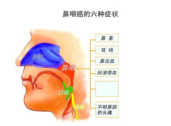 鼻咽癌，鼻涕中带血，鼻炎鼻窦炎，耳鸣耳闷，耳鼻喉科.jpg