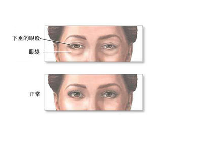 上睑下垂，眼科手术，上睑下垂的病因，双眼皮，眼科手术方式.png