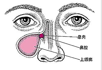 鼻息肉的危害你知多少？