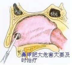 什么是鼻甲肥大？