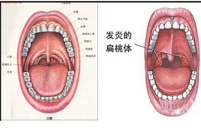 扁桃体炎的诱发原因你知道吗？