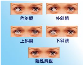 斜视可以手术治疗