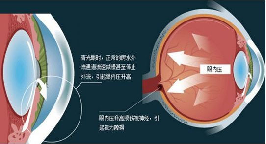 导致青光眼的原因