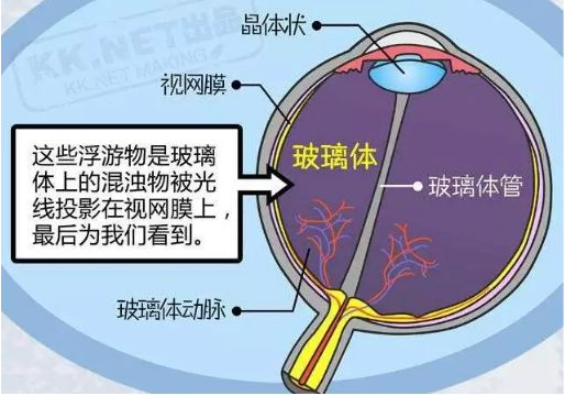 飞蚊症的危害