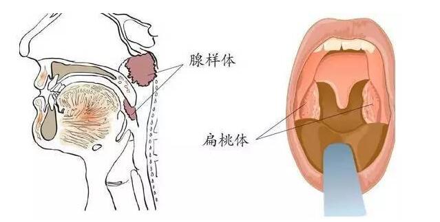 治疗腺样体的方法有哪些，腺样体肥大，腺样体的治疗方法，.jpg