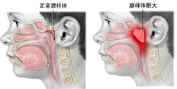 腺样体肥大的原因