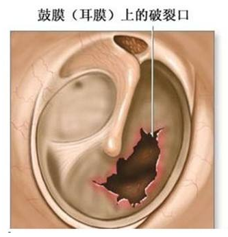 耳膜穿孔，中耳创伤，外耳道异物，中耳炎，鼓膜修补术.png
