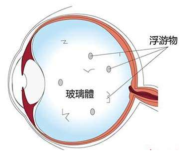 飞蚊症，眼睛，眼底出血，视力下降，失明.png