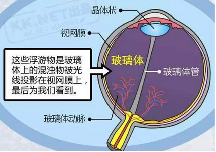 飞蚊症，玻璃体混沌，玻璃体浮游物，近视，失明.png