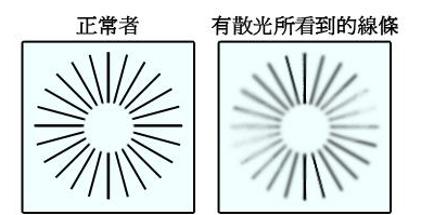 散光，眼科疾病，眼睛，视力，专业的医疗机构.png