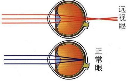 什么是远视眼